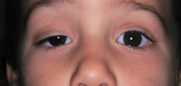 ما هى طرق علاج ارتخاء الجفن العلوى للعين ؟