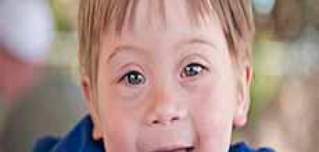 متلازمة داون المنغولية Down Syndrome