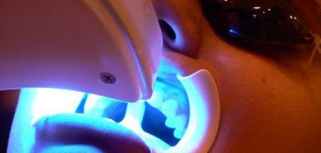 عملية تبييض الأسنان بالليزر