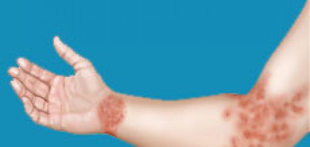 التهاب الجلد - الإكزيما